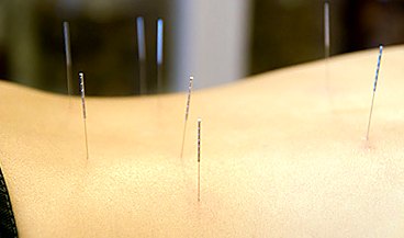 Fine acupuncture needles placed along the back