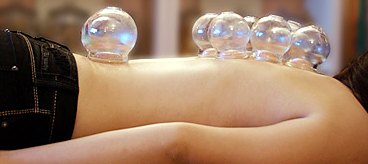 Glass cups applied to the back during cupping